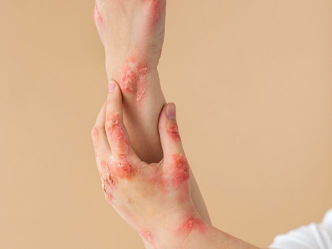 خيارات علاج الأكزيما للتقليل من تأثيراتها النفسية